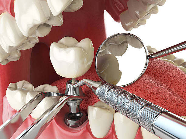Best Emergency Denture Repair in New Richmond, OH